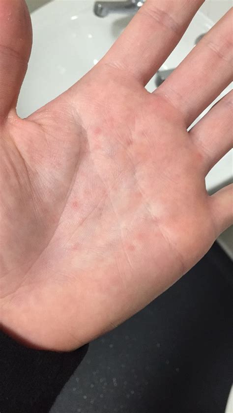 What Causes Red Rash On Palms Of Hands