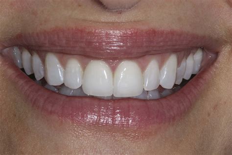 How To Make Bonded Teeth Whiter Teethwalls