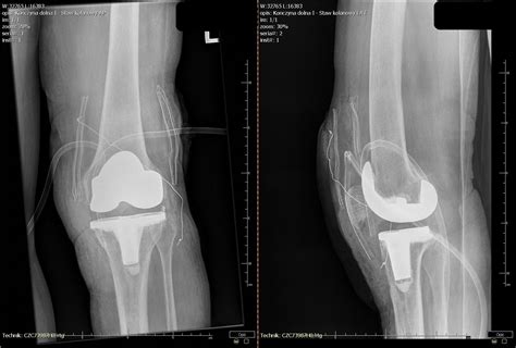 Hip Fusion Takedown With Total Knee And Hip Arthroplasty In A Patient