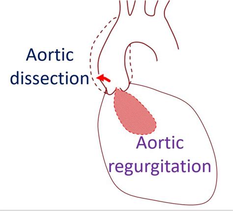Mechanisms Of Aortic Regurgitation In Aortic Dissection All About