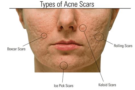 Types Of Acne Scars You Should Know M Aesthetic Clinic