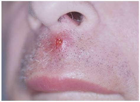 Staph Infection Symptoms Causes Diagnosis And When To See Doctor