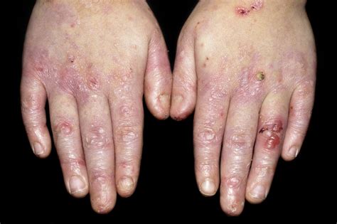 Epidermolysis Bullosa Dermatologic Disorders Msd Manual