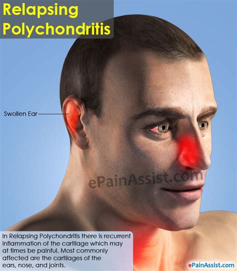 Relapsing Polychondritis Treatment Symptoms Causes