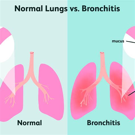 35 Is Bronchitis Contagious Through Kissing Pics Ammirasoi Free Hot