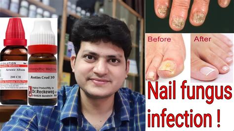 Update 138 Fungal Nail Infection Medical Name Best Vn