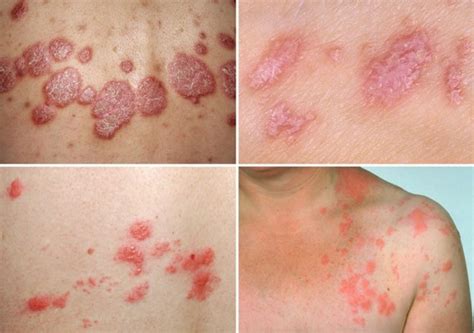 What Does Psoriasis Look Like Symptoms And Pictures
