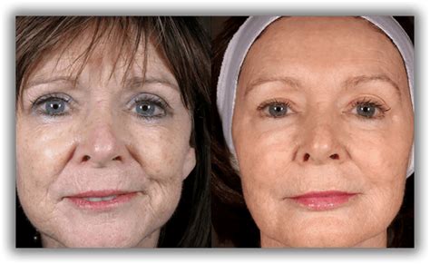 Thread Lift Before And After Pictures In Toronto And Mississauga Lip Doctor