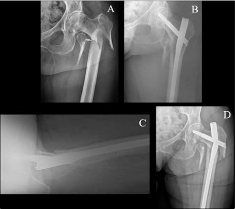 Figure 3 From Risk Of Revision After Hip Fracture Fixation Using Depuy