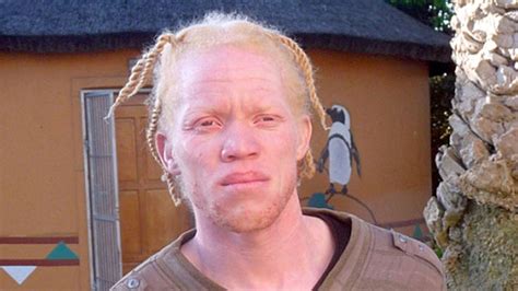 Albinos Get Tet Tansania Verbietet Wahrsagerei Welt