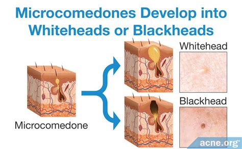 What Is Comedone Extraction And Should You Do It Acne Org