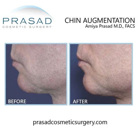 Chin Augmentation Chin Implant By Dr Amiya Prasad New York