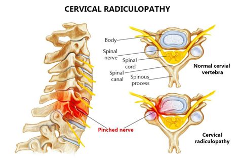 Cervical Radiculopathy Treatment Nyc Nerve Compression Specialists My