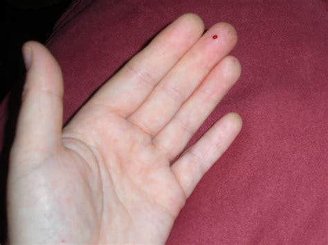 freckle on finger - pictures, photos