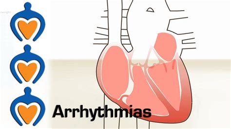 Arrhythmias What Is An Arrhythmia And How Is It Treated Cardiac