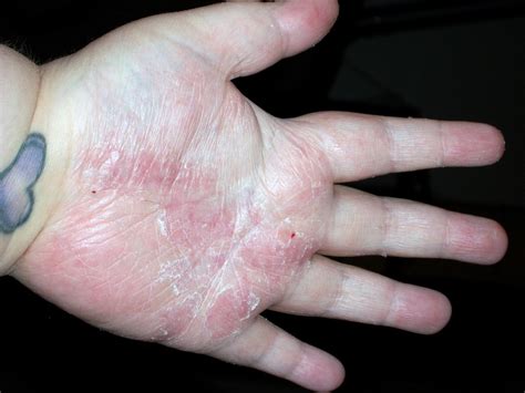 Psoriasis On Hands Pictures Photos