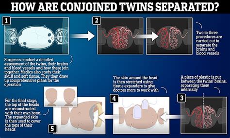 Conjoined Brazilian Twins Born With Fused Brains Are Separated In 27