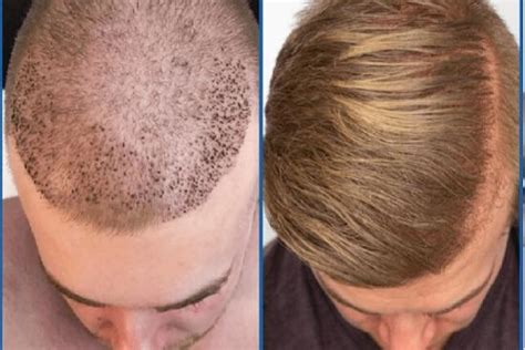 Hair Transplant Price Turkey From 1300 Clinics Costs