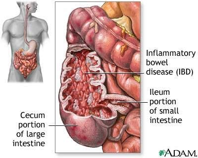 Inflammatory Bowel Disease Crohn S Disease And Ulcerative Colitis