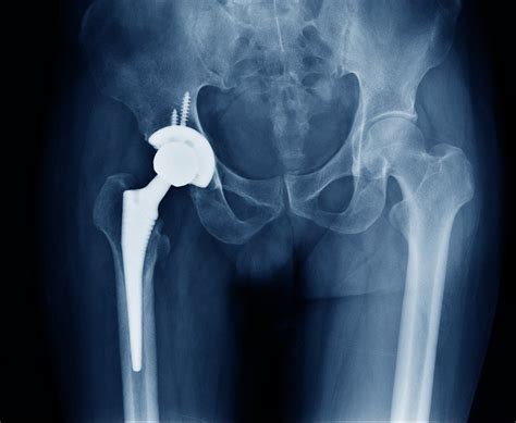 Hip Replacements