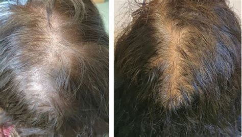 Normal Hair Parting Width Vs Thinning Causes Treatments And Results