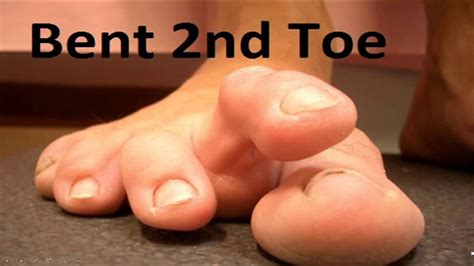 Hammer Toe Deformity The Complete Home Treatment Guide