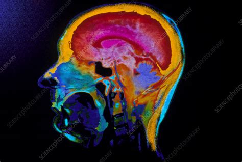 Coloured Ct Scan Of Sagittal Section Of The Head Stock Image P332