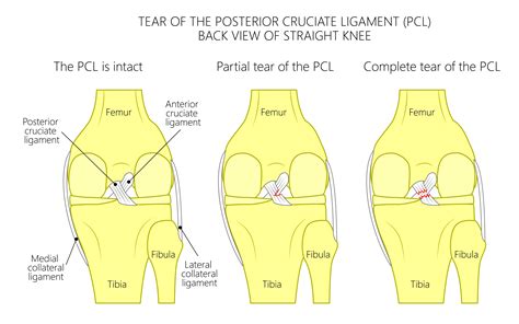 Acl Ligament Anatomy