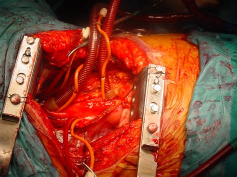 Ismics Beating Heart Mitral Valve Replasment In Redo Cardiac Surgery