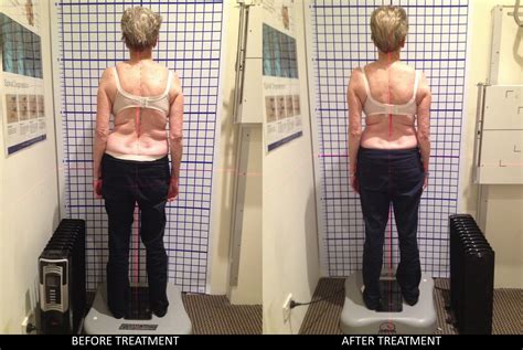 Before After Scoliosis St Judes Clinic
