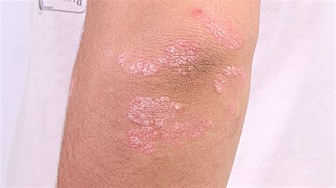 Psoriasis In Children Symptoms Treatments And More