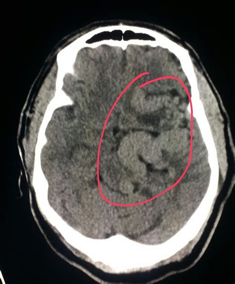 Brain Ct Shows A Tangle Of Large Dilated Abnormal Vessels Avm In