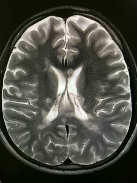 Subcortical Tubers Tuberous Sclerosis Radiology Imaging Medical