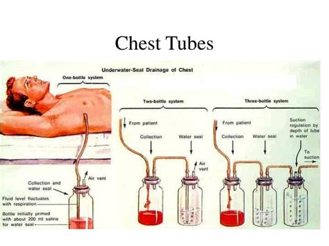 Managing chest drainage using a chest tube. Pemasangan WSD (Water Seal Drainage) / Chest Tubes