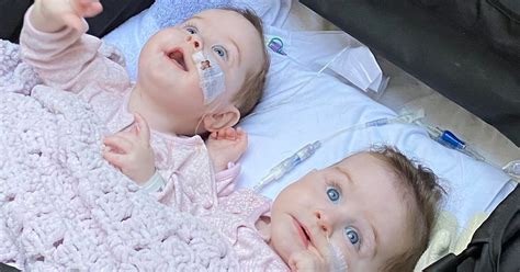 Ni Parents Share Photo Of Formerly Conjoined Twins After Successful
