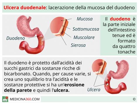 Ulcera Duodenale Sintomi Cura Dieta E Rischi Sanguinante O Perforata
