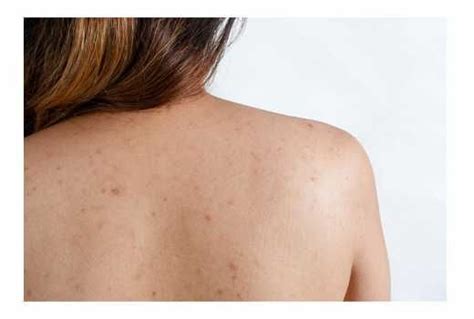Six Ways To Get Rid Of Shoulder Acne Diy Skin Care Skin Care Tips