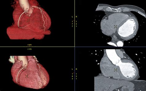 Ct Coronary Angiogram — Hurstville Private Heart Centre · Cardiology