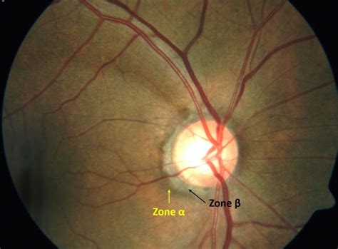 Optic Disc Changes In Glaucoma Eye Health Nepal