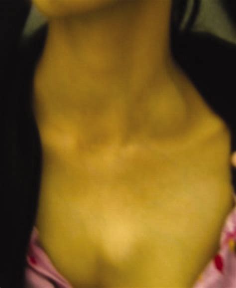 Chest Wall Swelling Unusual Presentation Of An Aggressive