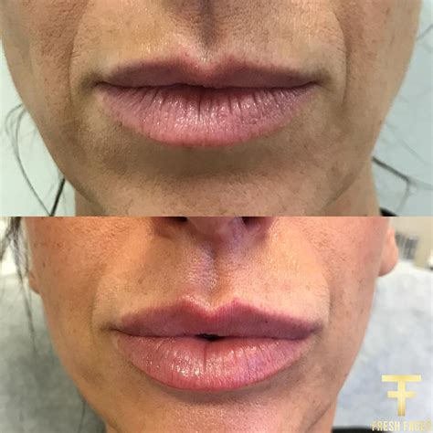 ✔ lip filler injection of lip fillers are counting as one of the most popular trends right now like face fillers. Best Lip Injections Perth. Fresh Faces Cosmetic Medicine