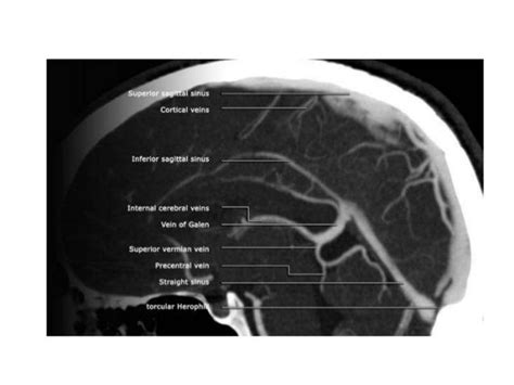 Occipital Sinus It Is The Smallest Of The Dural Venous Sinuses Andlies