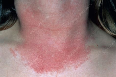 What Causes Red Rash On Chest Design Talk