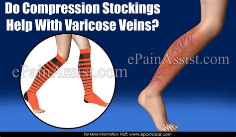 Do Compression Stockings Help With Varicose Veins