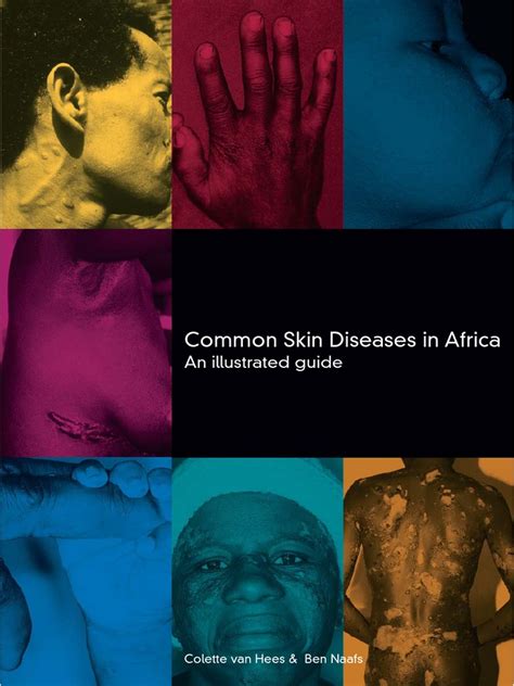 Derm Resource Commonskindiseasesinafrica 1 Pdf Dermatitis