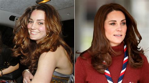 Does Kate Middleton Use Botox Plastic Surgery Expert Thinks Yes