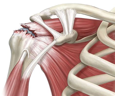Art Lander S Outdoors Rotator Cuff Injuries Are A Real Risk For Those