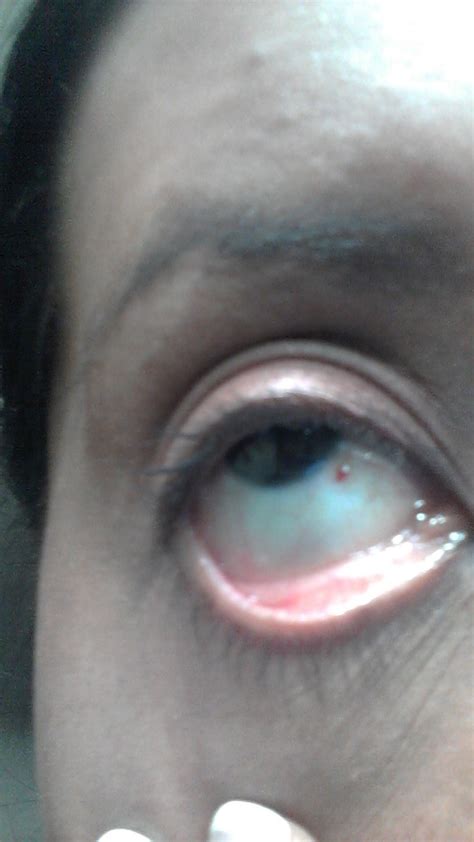Little Red Spot By Eye Lash See More Of Yoyo Nails An Eye Lash Spot
