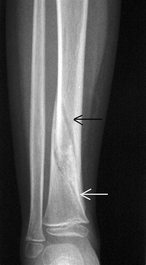 Toddler Fracture Frontal Radiograph Of A Young Ambulatory Infant Who