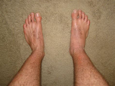 Sprained Ankle Swelling Comparison Of Ankle Sprain Swellin Flickr